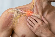 Neuropathie du nerf supraclaviculaire : douleur persistante après fracture ou chirurgie de la clavicule
