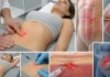 ACNES : quand une douleur abdominale vient de la paroi plutôt que des viscères ACNES : quand une douleur abdominale vient de la paroi plutôt que des viscères