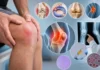 Genou qui gonfle sans traumatisme : arthrose, ménisque, inflammation ou autre chose ?