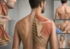 Lésion du nerf spinal accessoire : épaule tombante, trapèze faible et scapula instable Lésion du nerf spinal accessoire : épaule tombante, trapèze faible et scapula instable