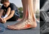 Maladie d’Iselin : douleur du cinquième métatarsien chez l’adolescent sportif Maladie d’Iselin : douleur du cinquième métatarsien chez l’adolescent sportif