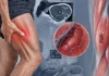 Myonécrose diabétique : une douleur musculaire rare qui exige un diagnostic médical