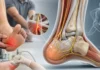 Neuropathie du nerf calcanéen médial : quand la douleur du talon n’est pas une fasciite