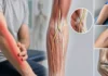Neuropathie du nerf cutané latéral de l’avant-bras : douleur après chirurgie ou prise de sang