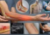 Neuropathie du nerf cutané médial de l’avant-bras : brûlure interne du coude et de l’avant-bras