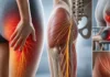 Neuropathie du nerf cutané postérieur de la cuisse : une pseudo-sciatique méconnue Neuropathie du nerf cutané postérieur de la cuisse : une pseudo-sciatique méconnue