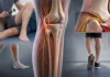 Neuropathie du nerf fibulaire commun : pied tombant et compression au col de la fibula Neuropathie du nerf fibulaire commun : pied tombant et compression au col de la fibula