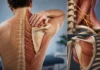 Neuropathie du nerf scapulaire dorsal : une cause méconnue de douleur entre les omoplates