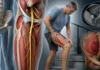 Neuropathie fémorale : faiblesse du quadriceps, douleur inguinale et drapeaux rouges Neuropathie fémorale : faiblesse du quadriceps, douleur inguinale et drapeaux rouges