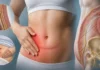 Névralgie ilio-hypogastrique : douleur de la paroi abdominale après chirurgie Névralgie ilio-hypogastrique : douleur de la paroi abdominale après chirurgie