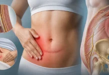 Névralgie ilio-hypogastrique : douleur de la paroi abdominale après chirurgie Névralgie ilio-hypogastrique : douleur de la paroi abdominale après chirurgie