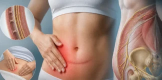 Névralgie ilio-hypogastrique : douleur de la paroi abdominale après chirurgie