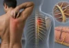 Notalgie paresthésique : quand une démangeaison sous l’omoplate vient d’un nerf