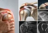 Os acromial symptomatique : quand une variante de l’acromion devient douloureuse