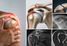 Os acromial symptomatique : quand une variante de l’acromion devient douloureuse Os acromial symptomatique : quand une variante de l’acromion devient douloureuse