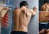 Paralysie du nerf thoracique long : comprendre la scapula alata Paralysie du nerf thoracique long : comprendre la scapula alata