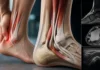 Peroneus quartus : quand un muscle accessoire contribue à la douleur latérale de cheville Peroneus quartus : quand un muscle accessoire contribue à la douleur latérale de cheville