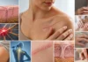Cicatrice sensible : comprendre la douleur et retrouver du confort Pourquoi une cicatrice peut-elle rester sensible longtemps après la guérison ?