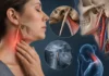 Syndrome d’Eagle : quand le processus styloïde contribue à la douleur de gorge Syndrome d’Eagle : quand le processus styloïde contribue à la douleur de gorge