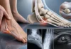 Syndrome douloureux de l’os péronier : une cause rare de douleur latérale du pied Syndrome douloureux de l’os péronier : une cause rare de douleur latérale du pied