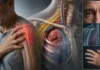 Tumeur de Pancoast : quand une douleur d’épaule cache une cause pulmonaire