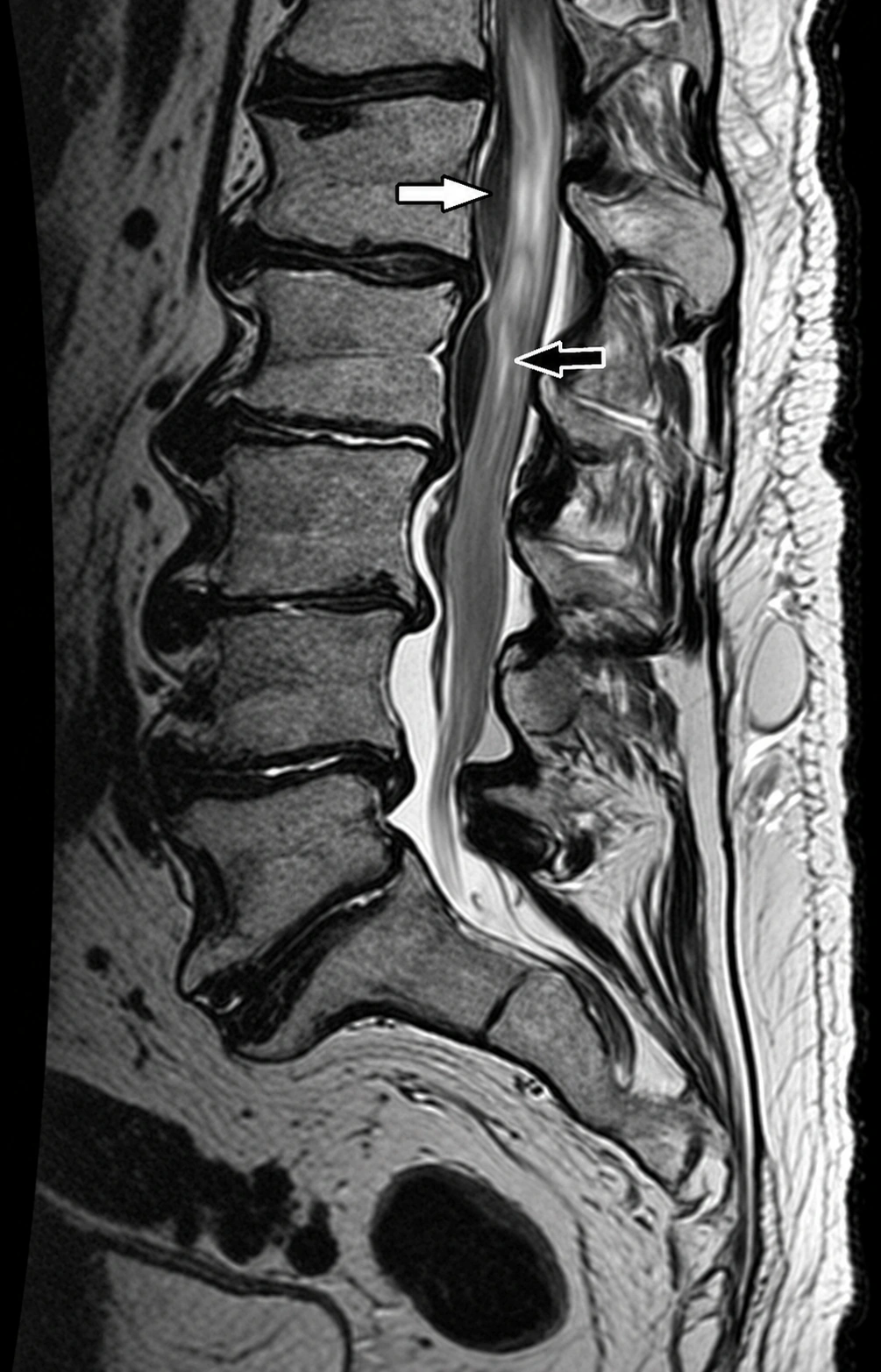 Thoracic MRI showing an epidural collection and spinal cord compression.