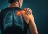 Tumeur de Pancoast : quand une douleur d’épaule cache une cause pulmonaire