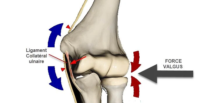 Schéma initial conservé en WebP : contrainte en valgus et région du ligament collatéral ulnaire.