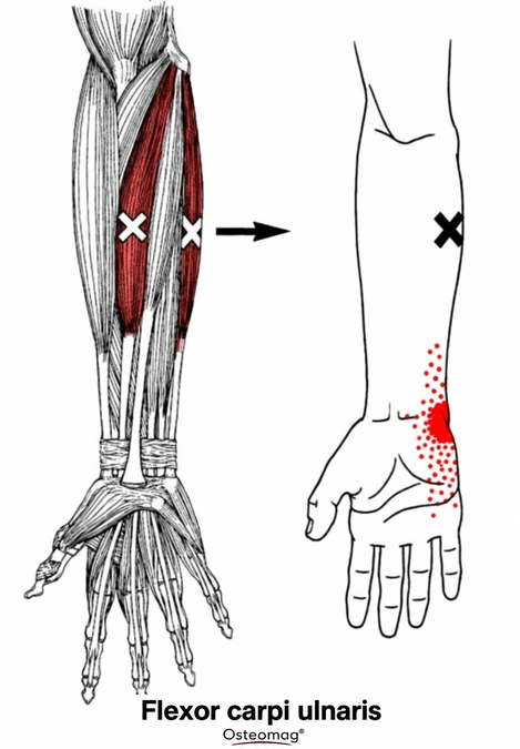 Old diagram of the flexor carpi ulnaris and an area of possible pain.