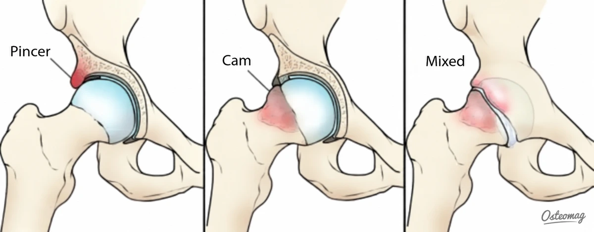 Simplified illustrations of pincer, cam, and mixed hip morphologies