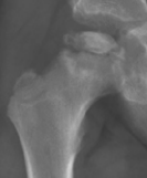 Petite radiographie initiale associée à la fragmentation de Perthes.