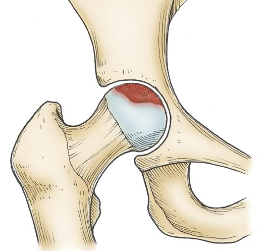 Schéma initial de fragmentation dans la maladie de Perthes.