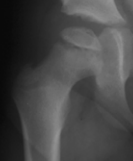 Petite radiographie initiale associée à la phase précoce de Perthes.