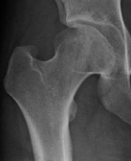 Petite radiographie initiale associée à la phase résiduelle de Perthes.