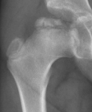 Petite radiographie initiale associée à la réossification de Perthes.