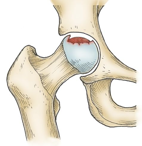 Schéma initial de réossification dans la maladie de Perthes.